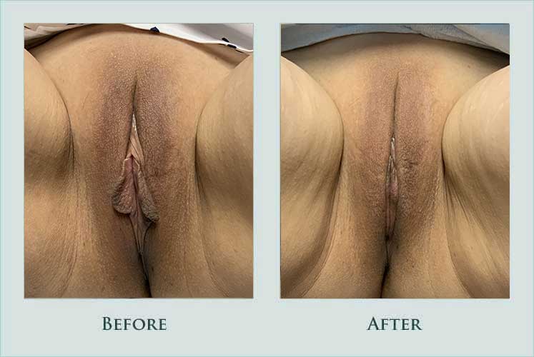 Before/after photos of procedure performed by Dr. Caroline Min - undefined